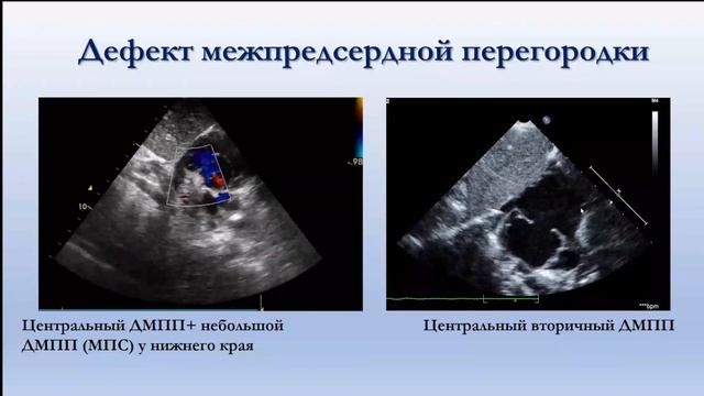 Эхокардиография в периоде новорожденности 24 11 2021
