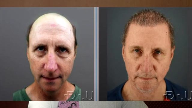 ПЕРЕСАДКА ВОЛОС: ЧТО НУЖНО ЗНАТЬ смотреть онлайн