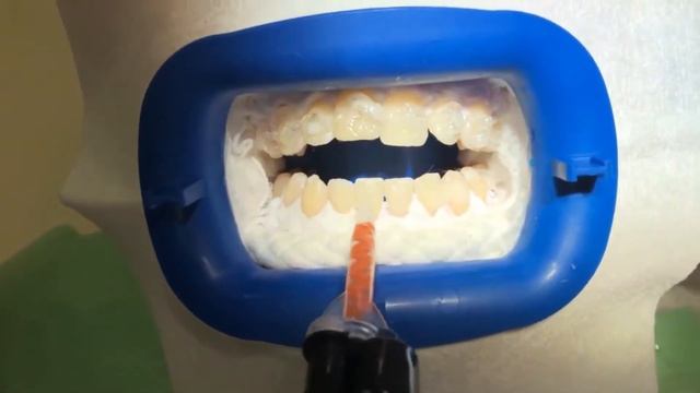 Отбеливание зубов ZOOM 4 смотреть онлайн