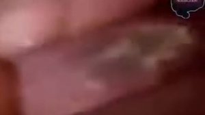 Крупнейшие Черноголовых, Zits, фурункулы, карбунку�