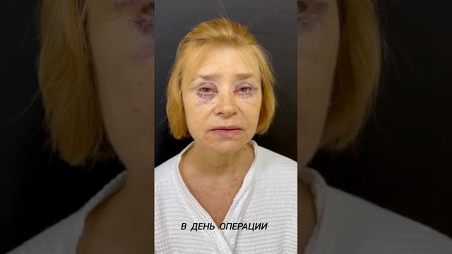 Через 10 часов после круговой блефаропластики смотреть онлайн