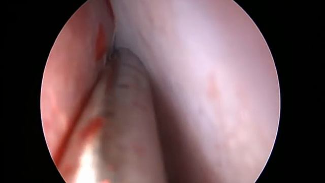 Септопластика смотреть онлайн