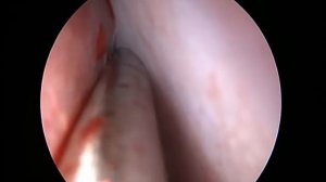 Септопластика