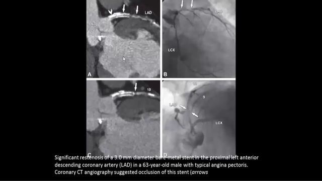 CT coronary Dr Ahmed Esawy смотреть онлайн