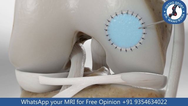 Cartilage क्या होता है, खराब हुए Cartilage को कैसे ठीक करें ? Knee Cartilage Complete Info in Hindi смотреть онлайн