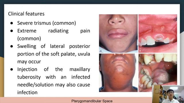 Spread of Oral Infection смотреть онлайн