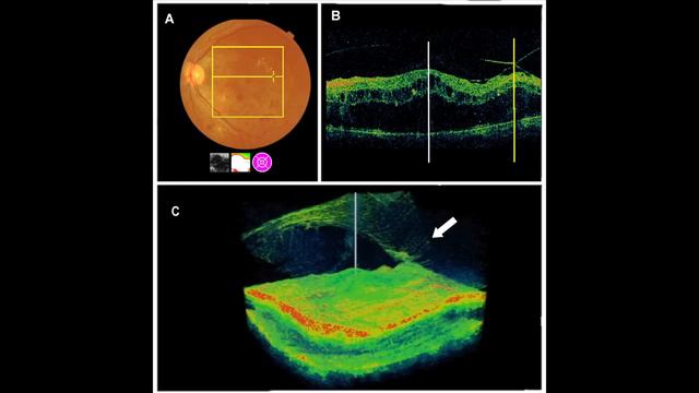a breakthrough: Extrafoveal Vitreous Traction - a major cause of Diabetic Macular Edema смотреть онлайн