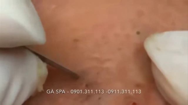 @setn угри выдавливание