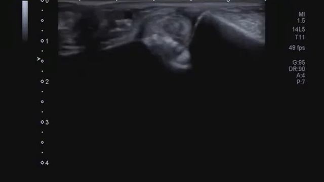 Латеральный скан через малоберцово-пяточную связку смотреть онлайн