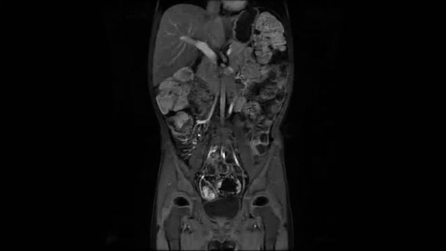 Contrast enhanced 3D T1 (LAVA FLEX) bowel MRI at 3.0 Tesla смотреть онлайн