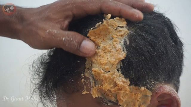 DANDRUFF SCRATCHING !!Big Scratching Dandruff Satisfying And Picking Psoriasis#310