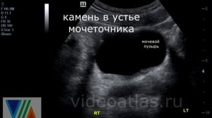 Камень мочеточника (еще один пример)