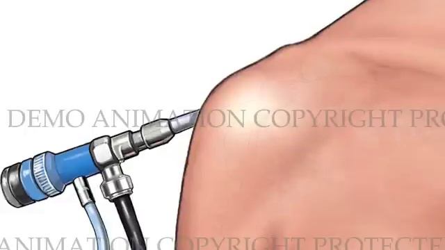 Complete Rotator Cuff Tear with Arthroscopic Repair смотреть онлайн