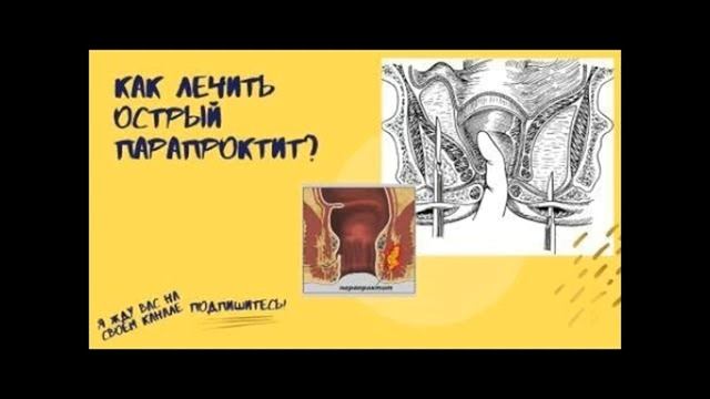 ПАРАПРОКТИ: коварный свищ и ложный стыд. смотреть онлайн