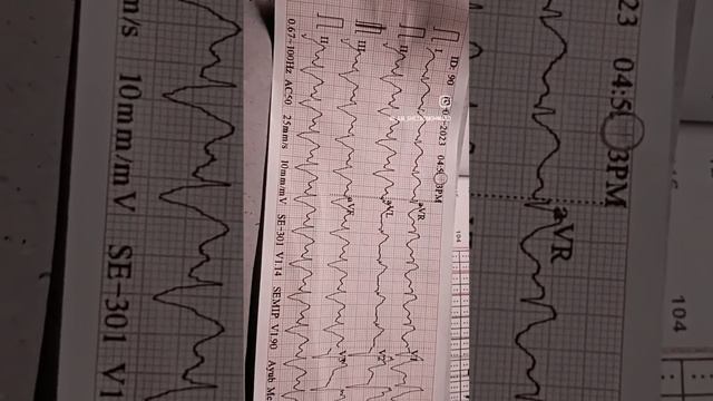 ECG of Antero-lateral wall MI with Right bundle Branch block. смотреть онлайн