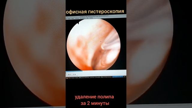 ОФИСНАЯ ГИСТЕРОСКОПИЯ. УДАЛЕНИЕ ПОЛИПА МАТКИ ЗА 2 МИНУТЫ. смотреть онлайн