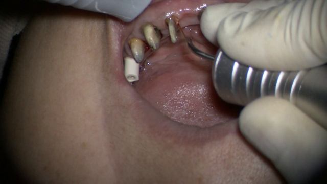 3 shape scanner digital impression of teeth and Straumann implants in mandible смотреть онлайн