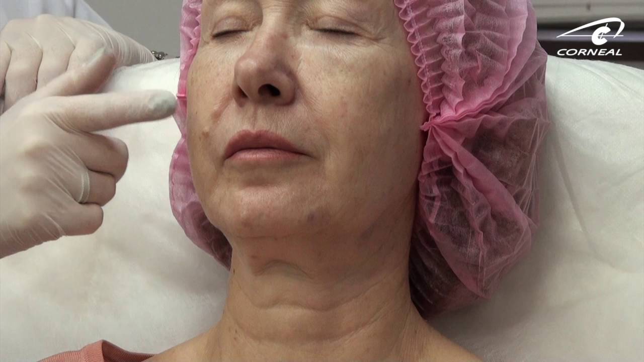 Первичная оценка пациента. Игла или канюля? смотреть онлайн