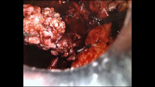 Robot Assisted Retroperitoneal, Pelvic and Inguinal Lymphadenectomy- A desperate attempt... смотреть онлайн