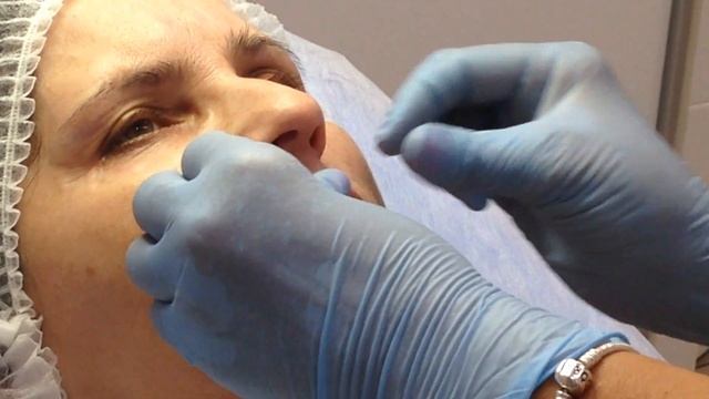 Меди Лайт Филлеры Заполнение губ ГК Сюджидерм 24ХР