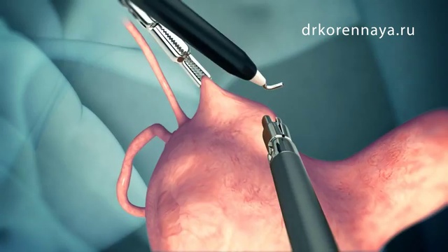 Миома матки. Хирургическое лечение смотреть онлайн