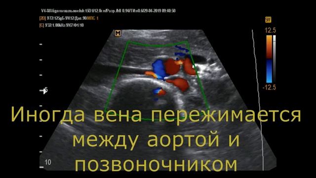 Ретроаортальная левая почечная вена на УЗИ сосудов(19 -7- 19 смотреть онлайн
