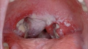 Фарингит симптомы