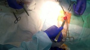 Устранение паховой грыжи