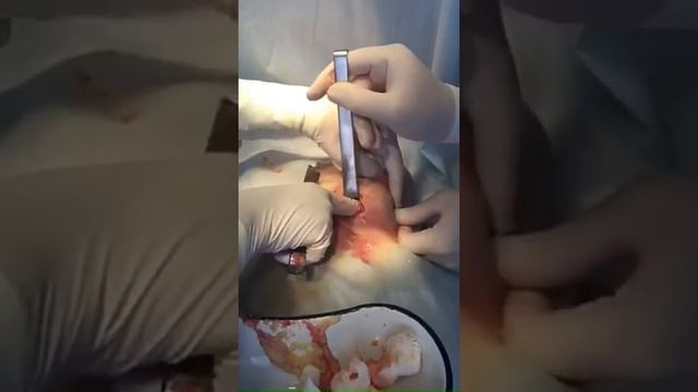 Удаление биогеля из молочной железы. смотреть онлайн