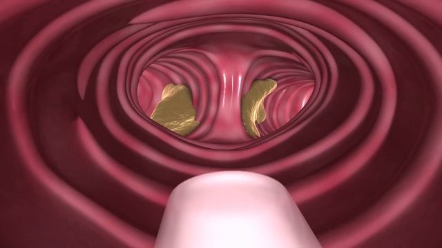 Nasotracheal suctioning (NTS) - 3D animation смотреть онлайн