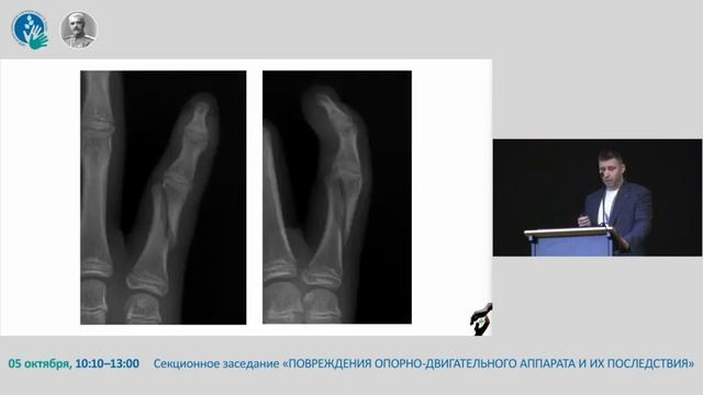 Особенности остеосинтеза фаланг пальцев кисти у детей.