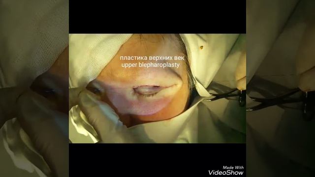 Пластика верхних век/Upper blepharoplasty смотреть онлайн