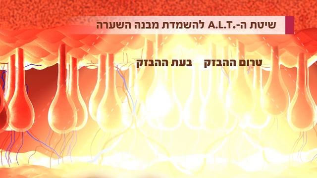 שיטה חדשנית להסרת שיער הייפר פולס של חברת LEONARDO HYPER PULSE ALT - אצלי בהילה ביוטי בוטיק עכו смотреть онлайн