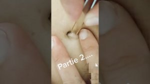 СЛАБОНЕРВНЫМ НЕ СМОТРЕТЬ/ ЧИСТКА ПУПКА