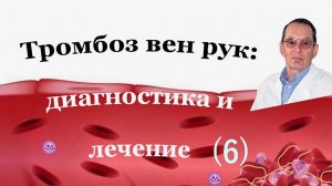 Тромбоз вен рук. Знания для ВСЕХ.
