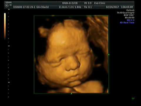 Первая улыбка малыша. 4D УЗИ