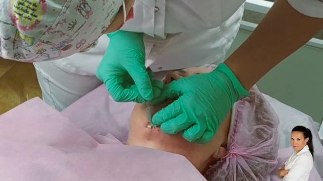 Нити в подбородок  Подтяжка подбородка нитями