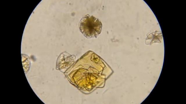 Моча под микроскопом. Кристаллурия 4 смотреть онлайн