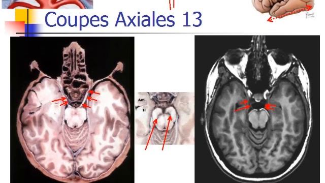 Dr Hasboun: Coupes axiales смотреть онлайн