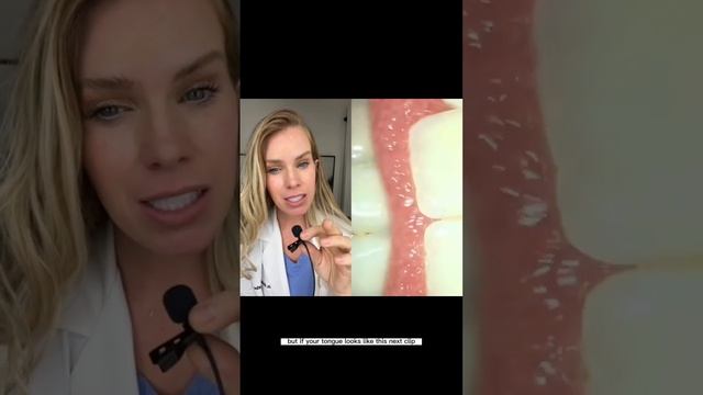 White, hairy tongue?! #tongue #tonguescraper #dentist смотреть онлайн