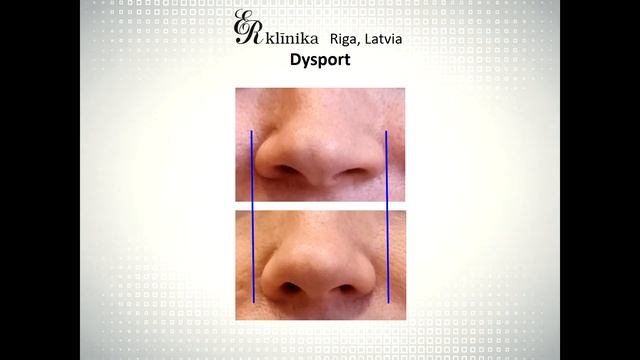 Botulīnterapija - Ботулинотерапия (Dr.V.Hramkovs / Др.В.Храмков) смотреть онлайн