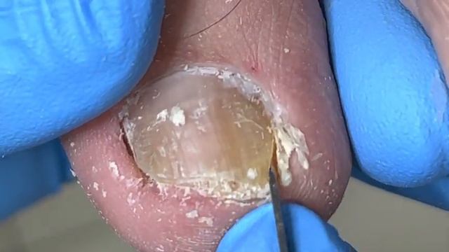 Hard toenails, vigorously trimmed【Xue Yidao Pedicure】 смотреть онлайн