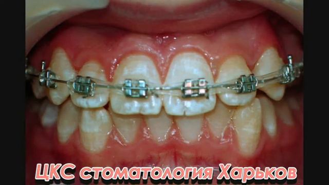лечение брекетами. Скученное положение зубов. смотреть онлайн