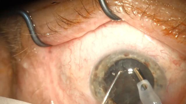 PHACO STUDIES (Stellaris PC 100PPS 80CT 20US): Corticonuclear cataract смотреть онлайн