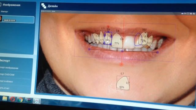 program design smiles , the DSD , photography in dentistry , veneers смотреть онлайн