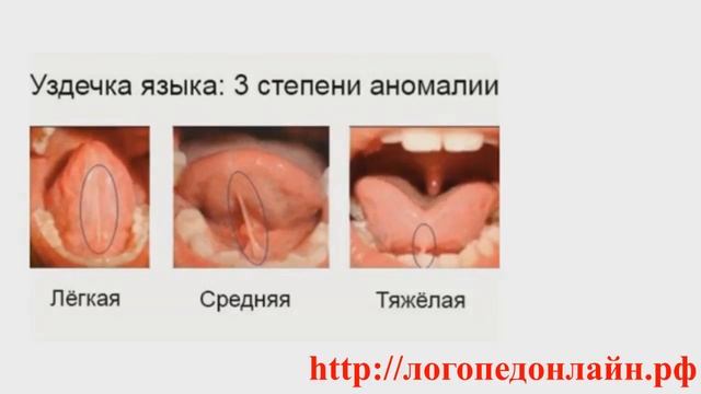 Что делать если у ребенка укороченная подъязычная уздечка? Короткая подъязычная уздечка у ребёнка. смотреть онлайн