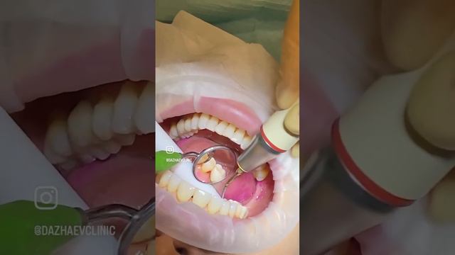 Зачем нужна профессиональная чистка зубов? смотреть онлайн