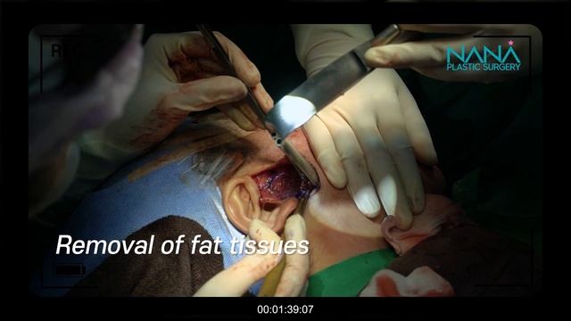 [LIVE SURGERY] Incisional Mid- Face Lifting, Thread Lifting For FOXY EYES, And Face Liposuction!