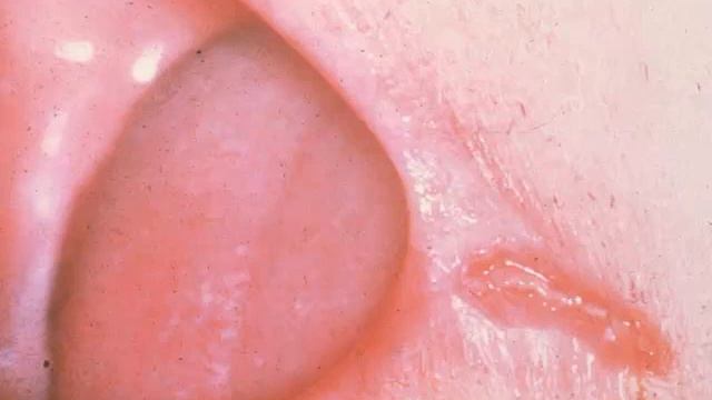 Angular Cheilitis Pictures смотреть онлайн