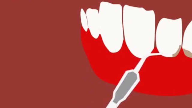 Ультразвуковая чистка зубов